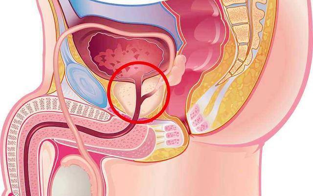 男性前列腺肥大，了解、識別與應(yīng)對，男性前列腺肥大，全面解析與應(yīng)對之道