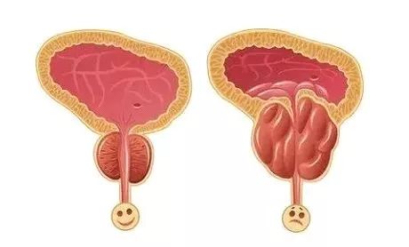老公的前列腺增大挑戰(zhàn)，理解、支持與共同對(duì)抗，老公前列腺增大，理解、支持與共同應(yīng)對(duì)的挑戰(zhàn)