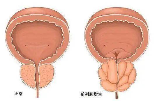 前列腺鈣化，一種常見(jiàn)的前列腺疾病及其相關(guān)知識(shí)解析，前列腺鈣化解析，常見(jiàn)疾病與相關(guān)知識(shí)探討