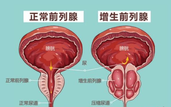 前列腺增生大小標(biāo)準(zhǔn)，理解其關(guān)鍵要素與影響，前列腺增生大小標(biāo)準(zhǔn)詳解，關(guān)鍵要素與影響因素解析