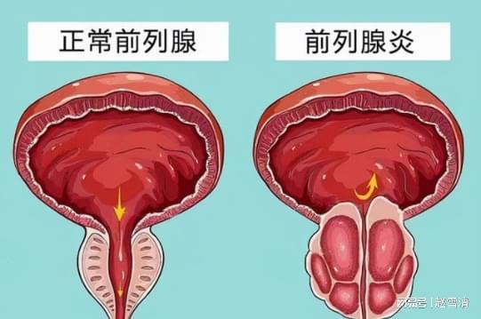 男性前列腺炎的癥狀解析，男性前列腺炎的癥狀詳解