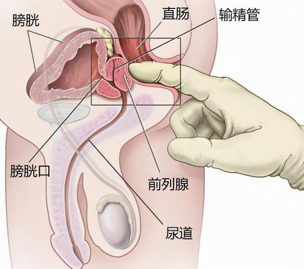 前列腺炎，重新認(rèn)識(shí)男性健康的誤區(qū)，重新認(rèn)識(shí)男性健康誤區(qū)，前列腺炎解析