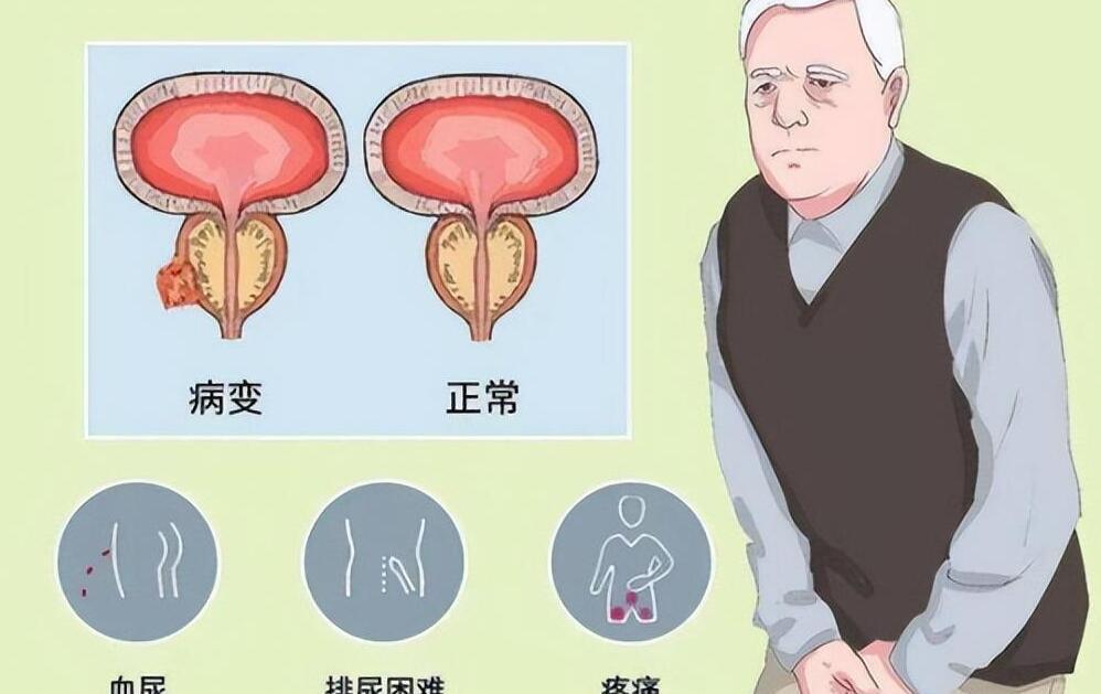 年輕人得了前列腺增大，理解、應(yīng)對與關(guān)注，年輕人前列腺增大，理解、應(yīng)對與關(guān)注的重要性