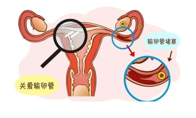 輸卵管堵塞的癥狀表現(xiàn)與解析，輸卵管堵塞的癥狀、表現(xiàn)與解析