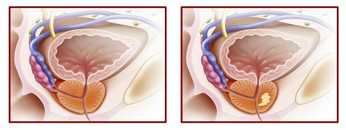 前列腺鈣化，揭示其潛在危害，前列腺鈣化，潛在危害揭秘