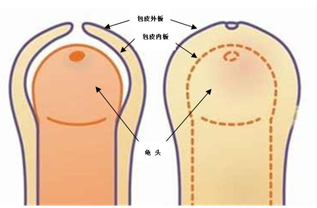 包莖及其相關(guān)圖片，了解、識(shí)別與處理，包莖詳解，圖片、識(shí)別、處理方法全攻略