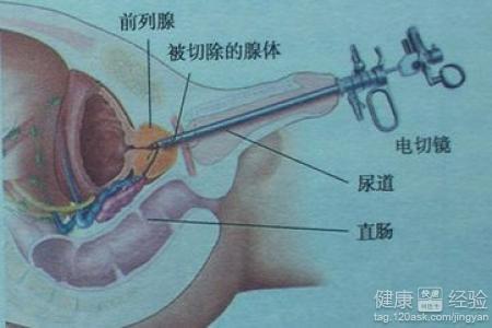 如何控制前列腺增生，如何控制前列腺增生的發(fā)展及癥狀？