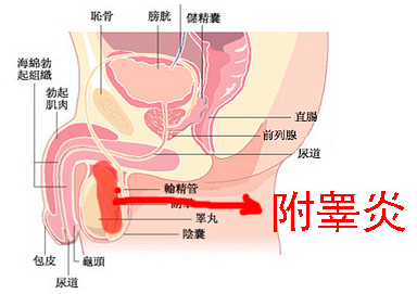 附睪炎，絕望中的希望曙光，附睪炎，絕望中的希望之光